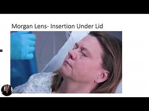 Ocular Irrigation