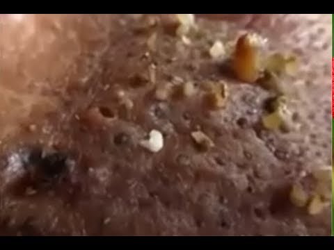 blackheads on back and shoulder-Most Satisfying Video Face Skin Care