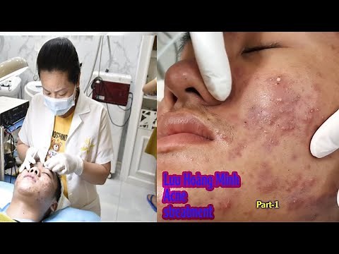 Acne treatment reputation, effective at Hien Van Spa|380I Lưu hoàng Minh