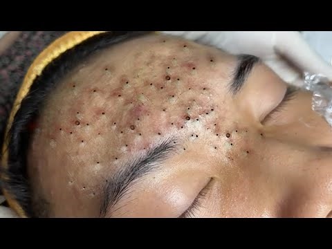 Remove Blackheads For Middle-aged Women