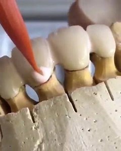 The birth of a crown 😍😍 | Dentistry World Update