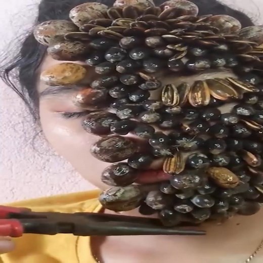 Removing Giant Blood Filled Ticks from Human Girl Face #amazing #ticks | World NT68