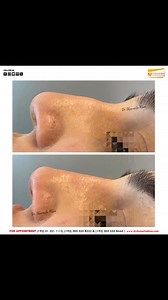 14 reactions | ✨ Elevate Your Beauty with Non-Surgical Nose...