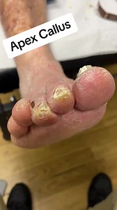 1.1K views | Satisfying apex of toe callus removal by australian . Podiatrist with a scalpel. Pressure causes the skin to harden and corns and callus to form #cornn# #callus #poditrist #australia #ergonx #docpods | Piesperfectosmx | Facebook