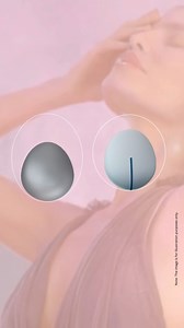 Why choose a lighter implant? Carrying extra weight can cause tissue sagging over time, which can often lead to discomfort, especially during physical activities like sports. B-Lite® implants, being up to 30% lighter than traditional implants, are engineered to reduce gravity's impact on your body. This means you can enjoy a more comfortable and active lifestyle without less strain on your tissues. Learn more about B-Lite®: https://polytech-health-aesthetics.com/en/my-breast-surgery/the-effect-o