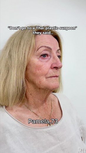 Facelift, Neck Lift & More: Full Facial Rejuvenation Results