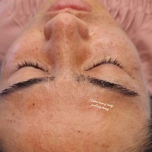 How often should you use cleanser on your face? twice a day In general, you should be cleansing your face at least twice a day. “You should wash your face both morning and night because the skin creates sebum and oil throughout the day,” Blackheads removal $-120 #blackheads #blackheadsremoval #blackhead | Face and Body Therapy Perth Australia | Facebook