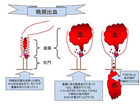 内痔核の治療法