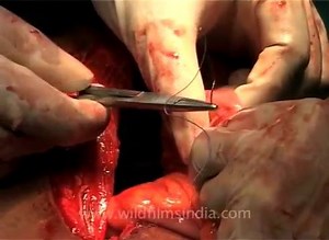 Internal abdominal stitching during surgery | Official_Medical Videos