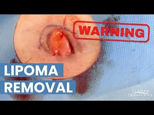 Lipoma Removal and Cyst Extraction by Dr. Timothy Jochen | CONTOUR DERMATOLOGY