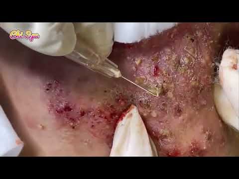 Alia's Beauty 114 Blackheads & Milia, Big Cystic Acne Blackheads Extraction Whiteheads Removal