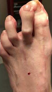 Pre dislocation second toe syndrome with plantar stump neuroma formation