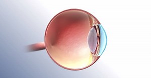 Wet Age-Related Macular Degeneration (AMD) is a condition that affects your eye-sight by causing blurred vision or a blind spot in your visual field. It's generally caused by abnormal blood vessels that leak fluid or blood into the macula, which is the part of the retina responsible for central vision. Learn More: http://bit.ly/2p15G16 | Bayer Middle East