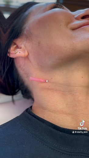 28 reactions | PDO Smooth Threads, a versatile service that can be used in many areas of the face as a substitute for — or complement to — dermal fillers, Botox, and surgical procedures. The PDO (polydioxanone) threads are inserted under the skin to tighten, lift, and smooth the treatment area. PDO threads can be used for many purposes, from facial lines and folds to improving crepey skin. | Clarity Skin in Draper | Facebook