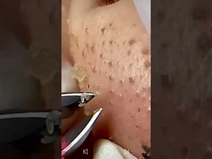 Skincare | Blackheads Removal #239 #tweezers skincare #blackheads blackheads