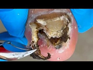 Completely Deteriorated Toenails, Cut Off The Fungus Step By Step【Xue Yidao】
