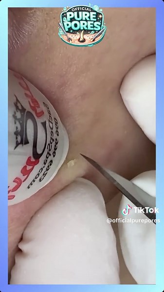 MEGA COMPILATION #29 - Official Pure Pores Skin Care React to Soothing facial treatments ASMR @officialpurepores #blackheadremoval #acneextraction Voice reaction and animations to Extreme blackhead removal, deep pore cleansing, intense acne extraction and satisfying skincare close-ups captured in HD and 4K macro detail. This video features real pimple popping, whitehead extraction, nose pore cleaning and deep skin cleansing designed to be relaxing and oddly satisfying. Watch clogged pores transf