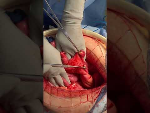 Correction of twisted ileal pouch-anal anastomosis (Graphic)