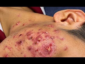 NEW 2026 🤯 Extreme Pimple Removal – Huge Acne Extraction#10310