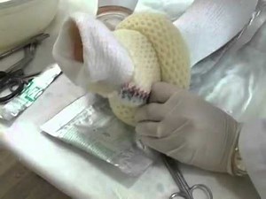 OsteoFx Full Leg Cast