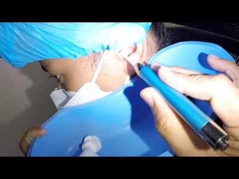 Removing Girl's Earwax Using Lighted Ear Pick