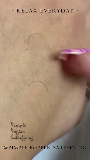 290_Daily_Satisfying_Blackheads_Pimples_Acne_and_Extractions_acne_blackhead_pimple_espinillas_pimplepopper_puntosnegros#spa #blackheads #pimple #glowing #pigmentation #whitening #acn #cosmetics #kosmetik #prp #estetica #blackhead #love #rosacea #obatjerawat #wrinkles #pimplepopping #peeling #oilyskin #acneproblems #hyperpigmentation #whiteheads #health #acneskincare #dermaplaning #beautiful #bhfyp #skinhealth #beautycare #organic #acne #skincare #beauty #skin #skincareroutine #antiaging #acnetre