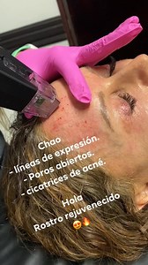 1K views · 22 reactions | Morpheus 8 facial, desde Beverly Hills a CR ❣️ Visítanos y descubre porqué somos líderes en técnica y tecnología. Citas y consultas al 4702-7557 o via WhatsApp 6259-6266. | Dra. Vargas - Laser Sculpture Medical Clinic | Facebook