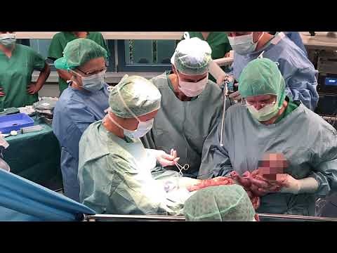 Baby kommt nach Gebärmuttertransplantation auf die Welt - Uniklinik Tübingen