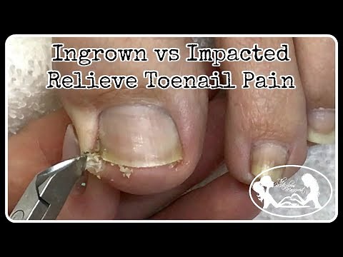 Ingrown Toenail and Impacted Toenail Relief and Prevention PedicureTutorial