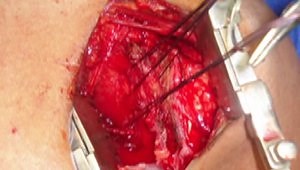 Chronic Locked Posterior Dislocation Of The Shoulder - A New Surgical Approach