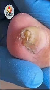 Covered Elderly Foot Health Maintenance Plans #DiabeticFootCare #FootSupport #EverydayCare | Evgeniy