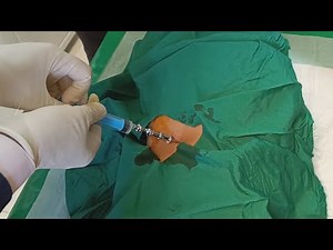 Bone marrow aspiration | Intra-cerebrospinal fluid chemotherapy in the patient with blood cancer