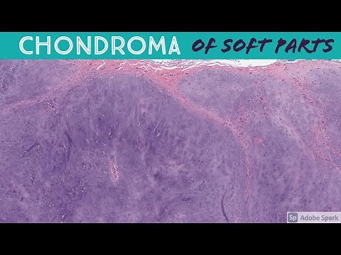 Chondroma of Soft Parts (Extraskeletal Chondroma)