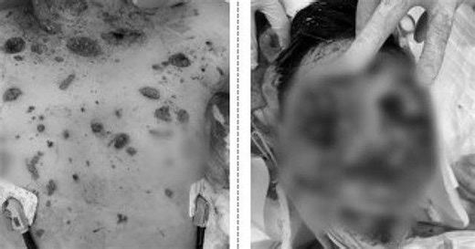 Bé trai tử vong sau khi bị đa chấn thương do laptop phát nổ