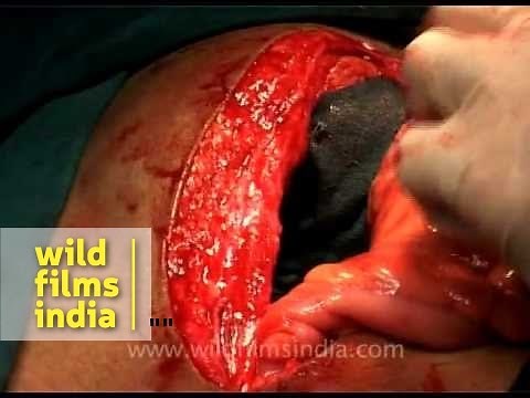 Abdominal exploration - Laparotomy