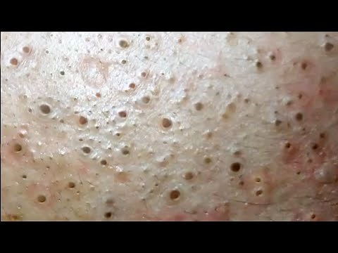 Multiply Blackheads on Forehead - Blackheads Removal
