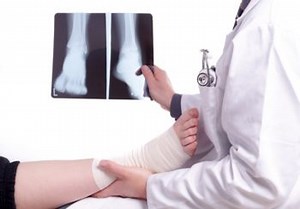 What is a Displaced Fracture and How is it Treated?