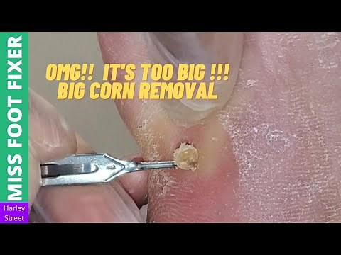 It's too big!! Big Corn removal | Miss Foot Fixer