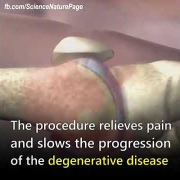 Stem cell treatment, PRP injection for treatment knee osteoarthritis, painful knee