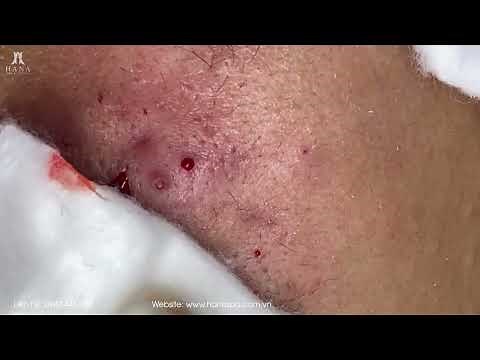 Big Cystic Acne Blackheads Extraction Blackheads & Milia, Whiteheads Removal Pimple Popping