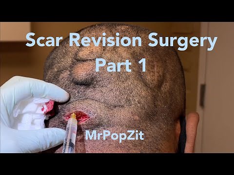 Scar revision surgery part 1. Removal of fibrous scar tissue from chronic Pilar cyst patient.