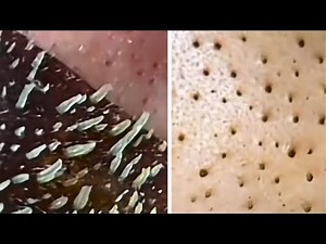 Experience satisfying blackhead ASMR on nose compilation for ultimate relaxation and skincare tingle