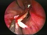 Nasal Septoplasty - Endoscopy • Video • MEDtube.net