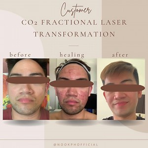 The journey isn’t easy but it’s always worth the shot. Co2 Fractional Laser is a type of skin treatment that reduce the appearance of acne scars, deep wrinkles, and other skin irregularities. It is a non-invasive procedure that uses laser, specially made of carbon dioxide, to remove the outer layers of damaged skin. It uses short-pulsed light energy (known as ultra pulse) that is continuously blasted through a scanning pattern in order to remove thin, outer layers of damaged skin. Once the dead 