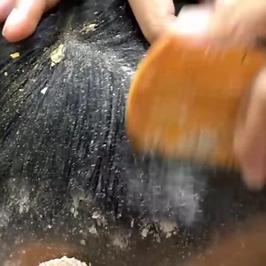 Ah Ha Worm Hole Flakes So Big !! Dandruff Removal Itchy Scalp Satisfying #399 Part 10 | Help remove ticks