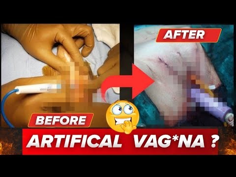 Gender Affirmation Surgery Explained: How Male to Female Surgery Actually done🤯@BioSapien2.0