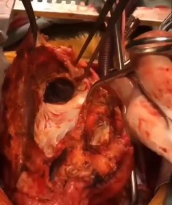 How Heart Transplant Surgery Look Like