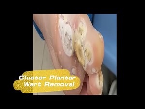 [ASMR] Plantar Warts Removing with Ancient Pedicure Technique