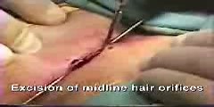 Laying Open Technique and Live Pilonidal Cyst...