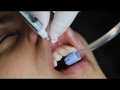 Laser Gingivectomy to Correct Gummy Smile